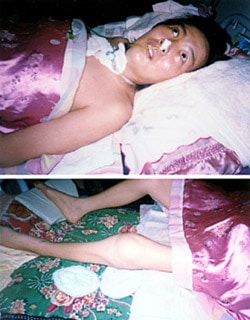 35-year-old Ms. Li Huiqi was tortured for two months in a Chinese Labor Camp, leaving her paralyzed and emaciated.
